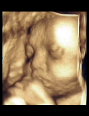 胎児超音波診断画像２