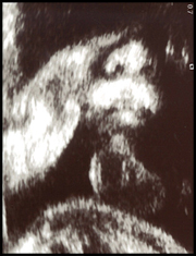 胎児超音波診断画像３
